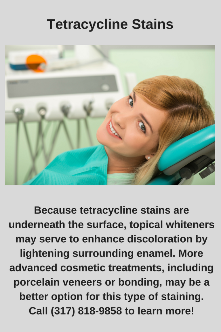 can-tetracycline-stains-be-whitened-john-r-phelps-dds